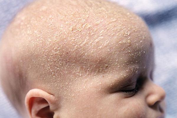 درمان ریزش پوست سر نوزاد؛ به روزترین نکات و روشهای درمانی