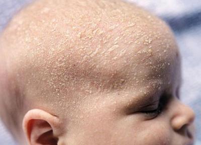 درمان ریزش پوست سر نوزاد؛ به روزترین نکات و روشهای درمانی